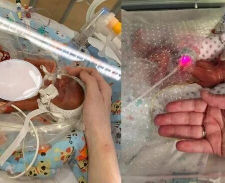 Πρόωρο μωρό γεννήθηκε μόλις 420γρ στις 21 βδομάδες, 16 μηνών σήμερα χαμογελάει στην αγκαλιά των γονιών του